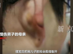 概率之争：男子理发耳朵被剪裂，店方称属偶然事件